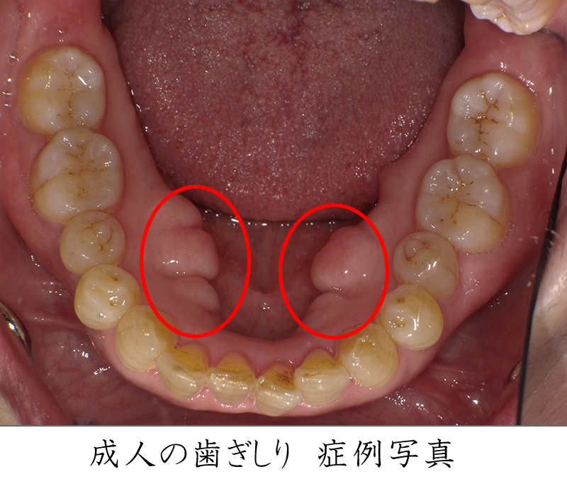 成人の歯並び