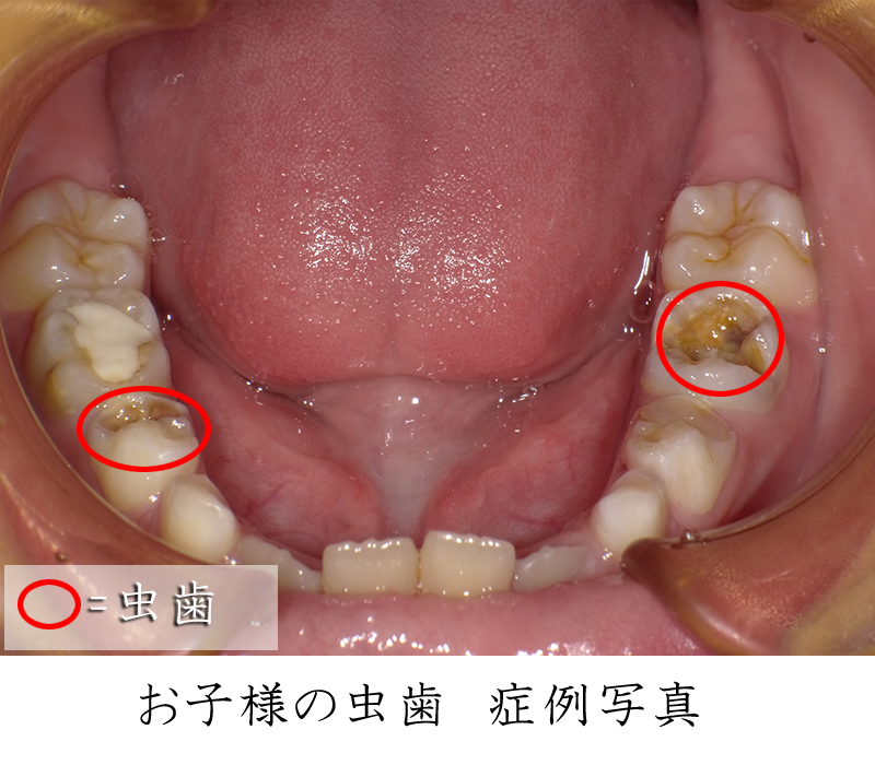 子供の虫歯症例