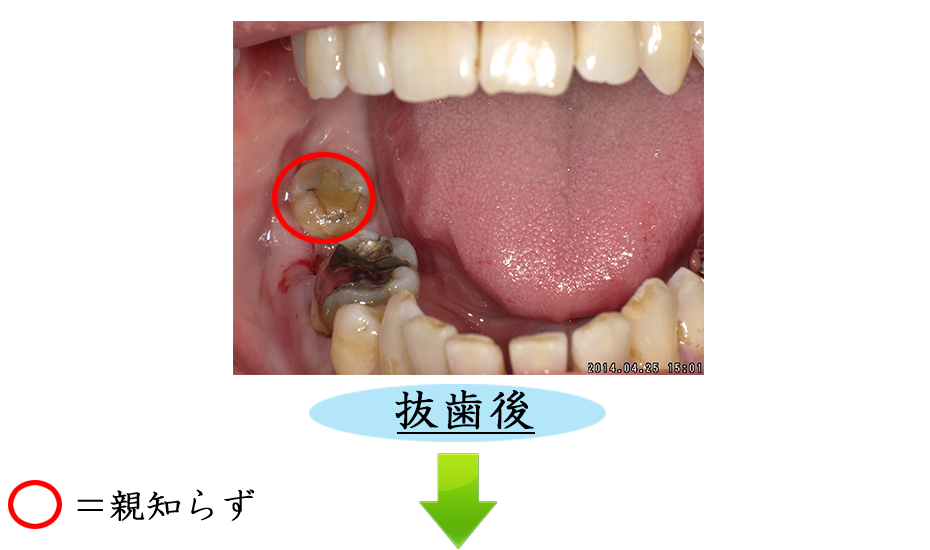 親知らずの症例