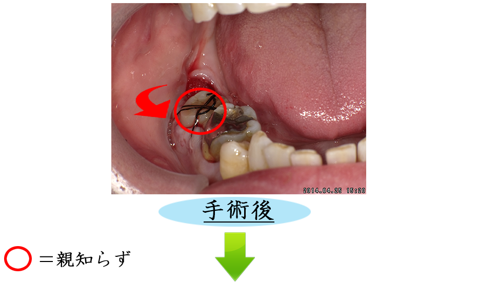 親知らずの症例