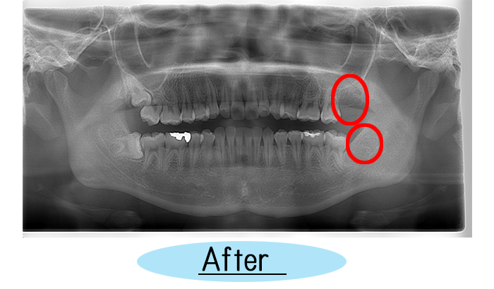 親知らずの症例