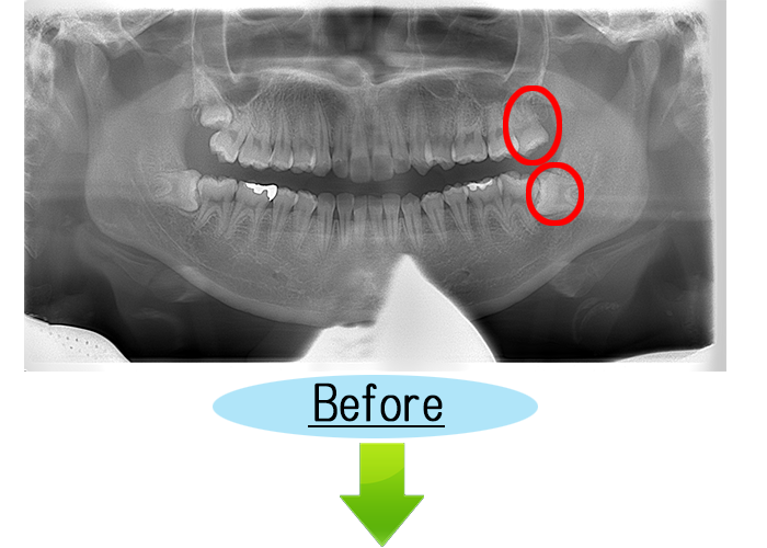 親知らずの症例