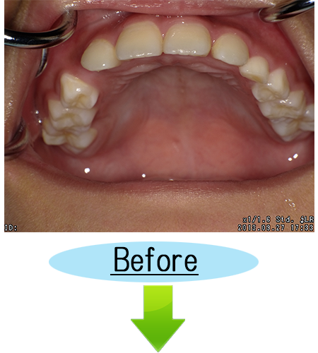 小児矯正（拡大床）