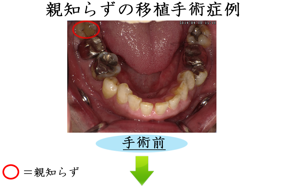 親知らずの症例