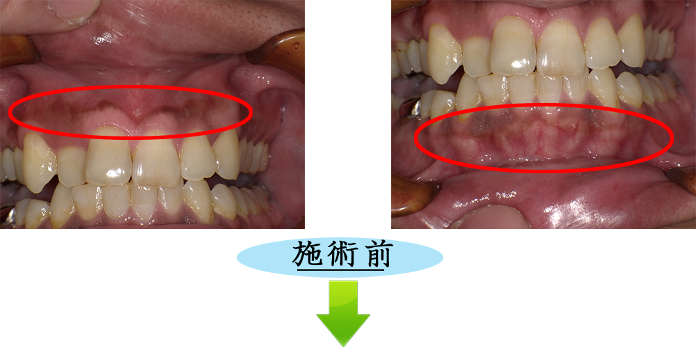 ガムピーリング治療