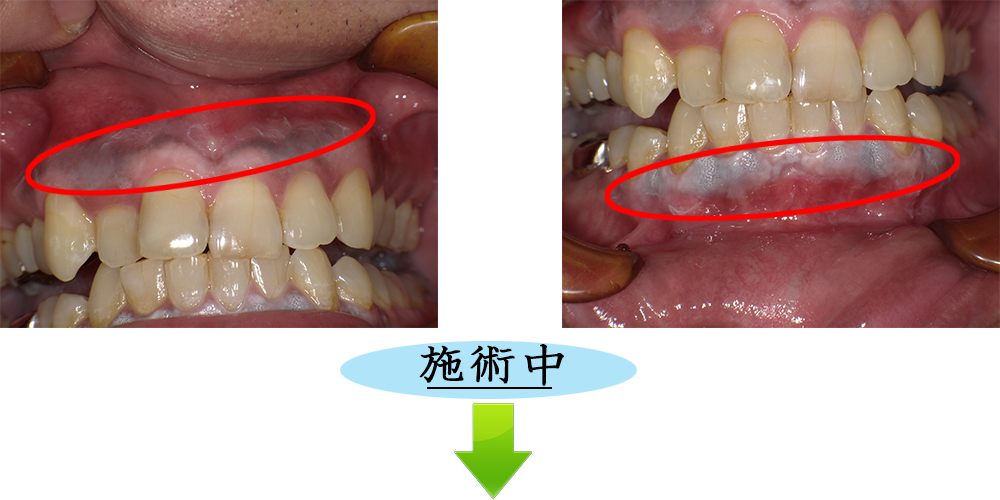 ガムピーリング治療