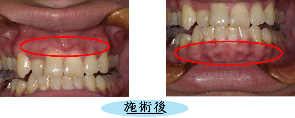 ガムピーリング治療