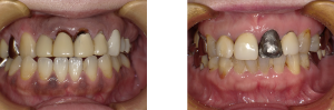 前歯のかぶせ物の劣化やはがれた症例