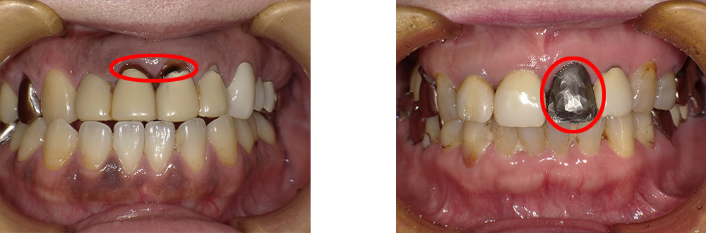 前歯の被せ物の劣化や剥がれの症例