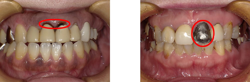歯 表面 剥がれ た