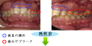 歯周病1