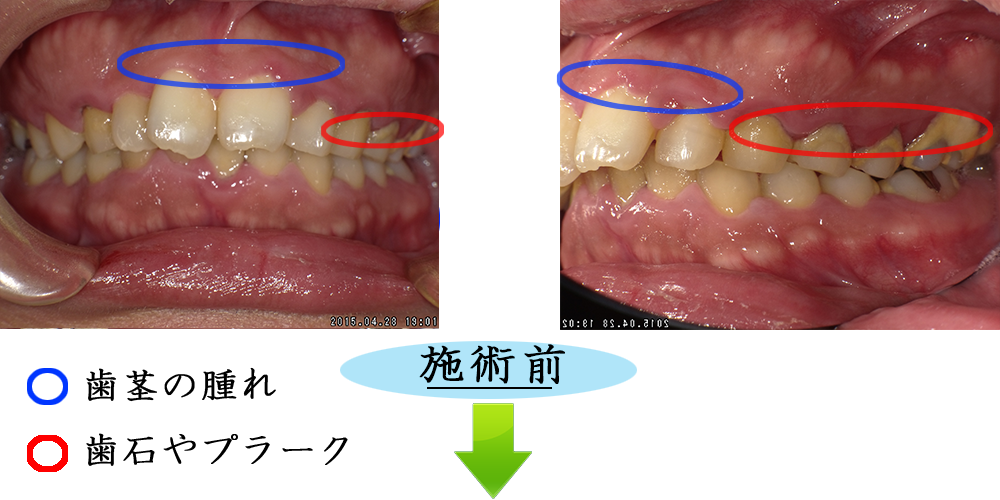 歯周病1