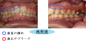 歯周病22
