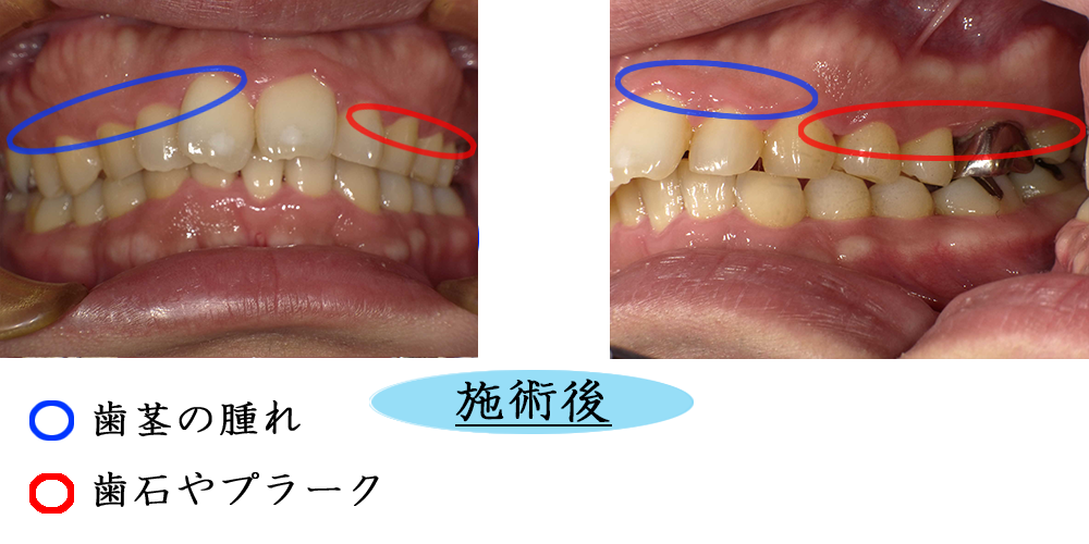 歯周病②