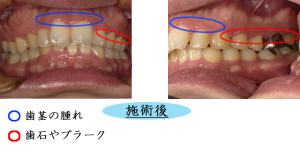 歯周病②