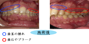 歯周病１