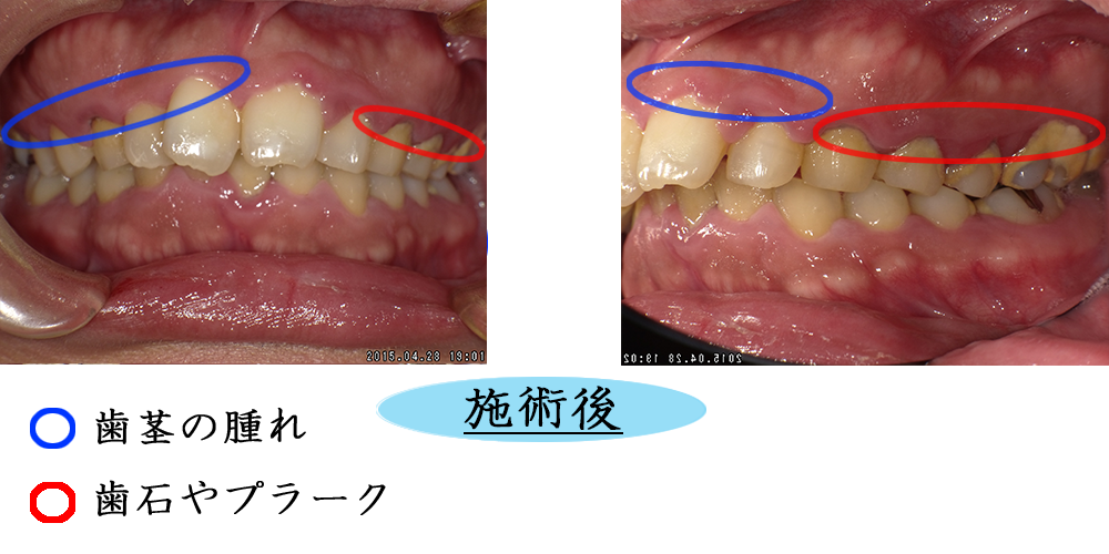 歯周病1